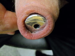 Penis plug 18mm,5cm in the external meatus with closed foreskin
