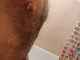 streched nipples